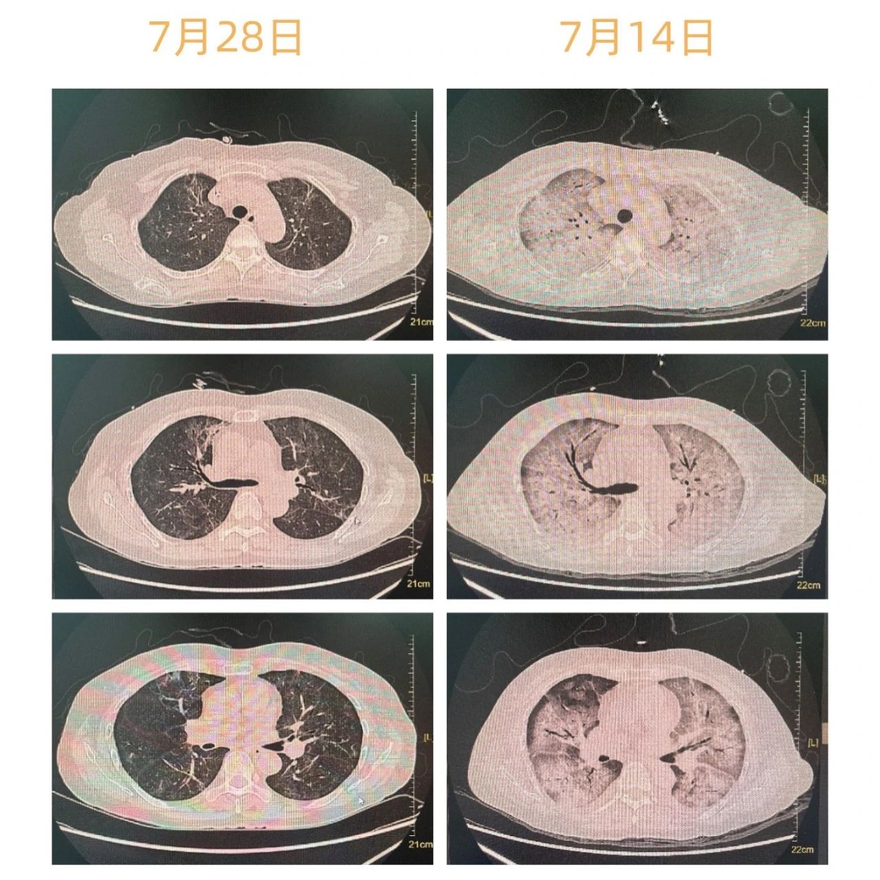 19天逆转致命“白肺”！中医药精准辨证，这家中医院让重症患者免于插管